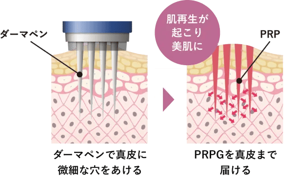 ダーマペン：ダーマペンで真皮に微細な穴をあける。PRPGを真皮まで届ける。