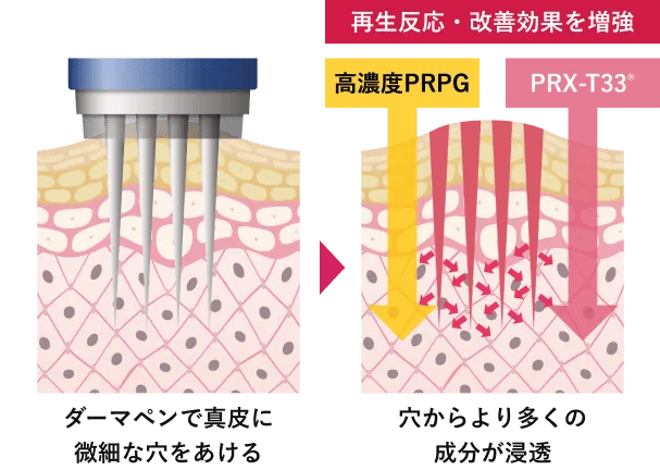 ダーマペンで真皮に微細な穴をあける。穴からより多くの成分が浸透
