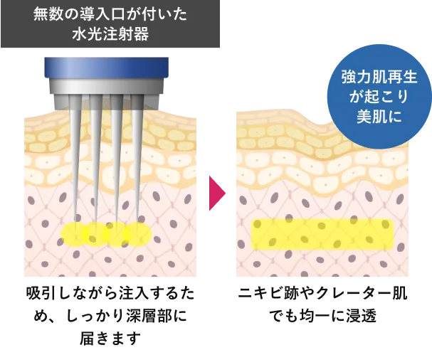 無数の導入口が付いた水光注射器：吸引しながら注入するため、しっかり深層部に届きます。⇒ニキビ跡やクレーター肌でも均一に浸透