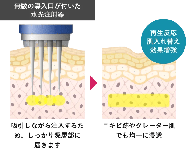 無数の導入口が付いた水光注射器⇒再生反応肌入れ替え効果増強