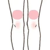 膝上（両側）の施術イメージ