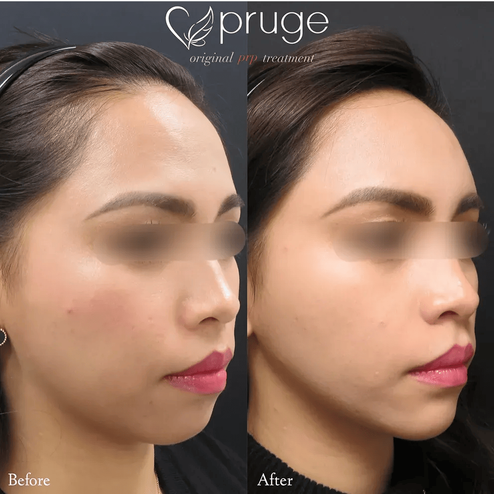 PRP注射：施術部位 額・こめかみ、ほうれい線 / pスリム注射：施術部位 ほうれい線上〜フェイスライン