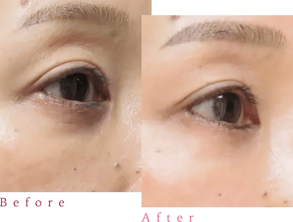 脱脂術後の修正