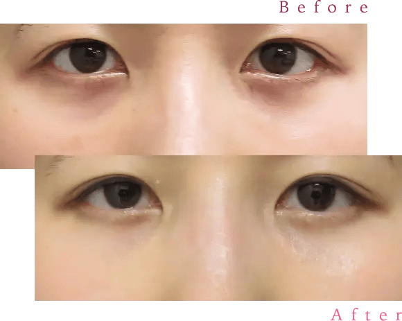 脱脂術＋脂肪注入後の修正