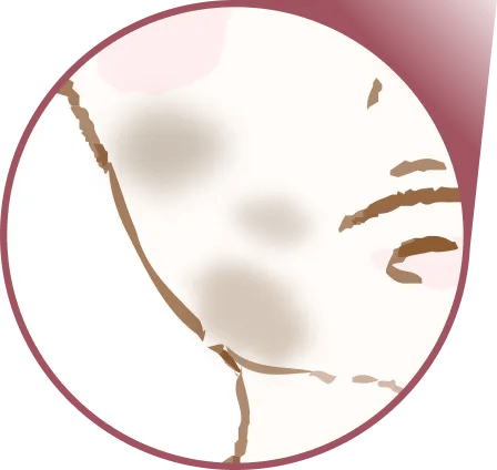 色素沈着