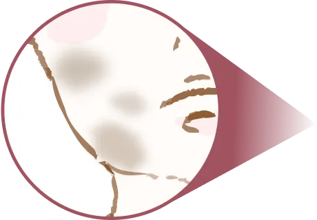 色素沈着