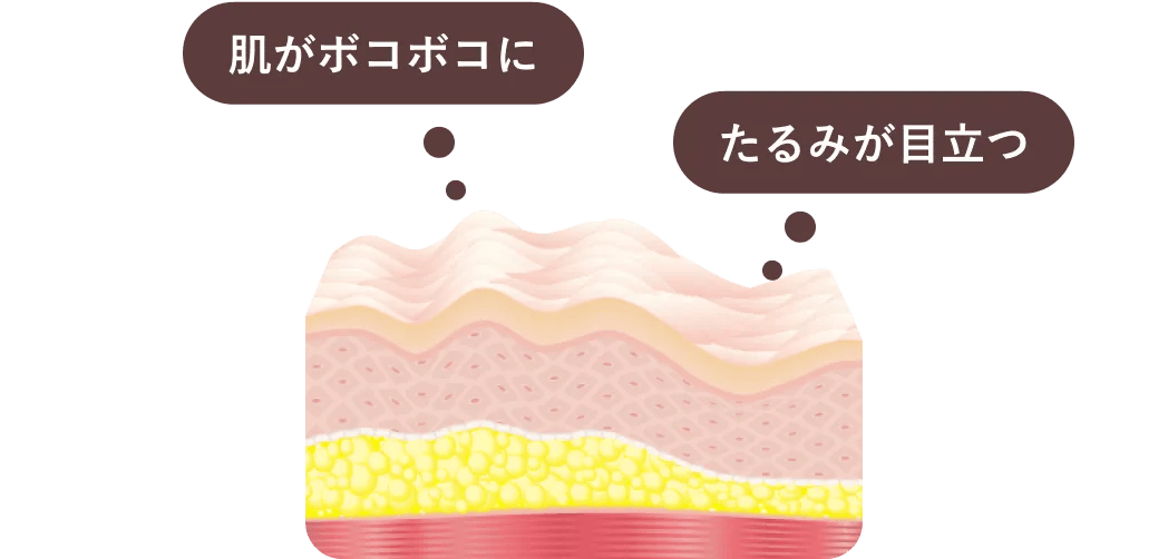 肌がボコボコに、たるみが目立つ