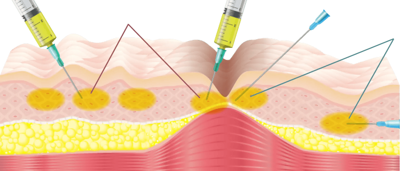 注射針で表層からも細かく注入・癒着を剥離しながら広い範囲に注入