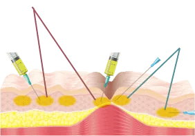 注射針で表層からも細かく注入・癒着を剥離しながら広い範囲に注入