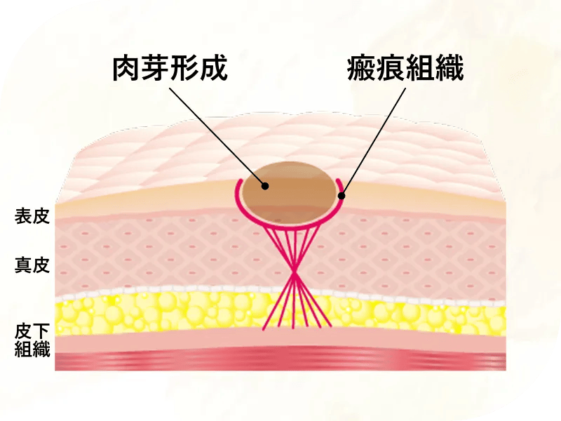 瘢痕や陥凹にもアプローチ