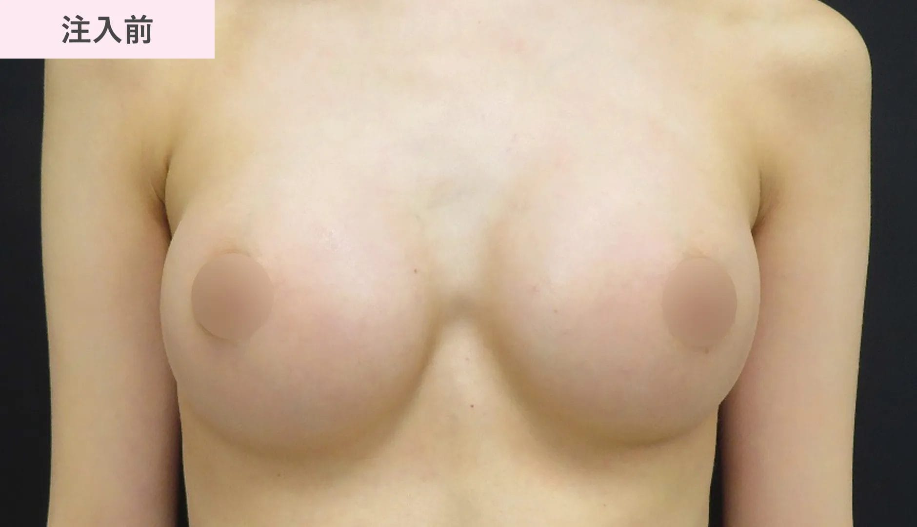 注入前