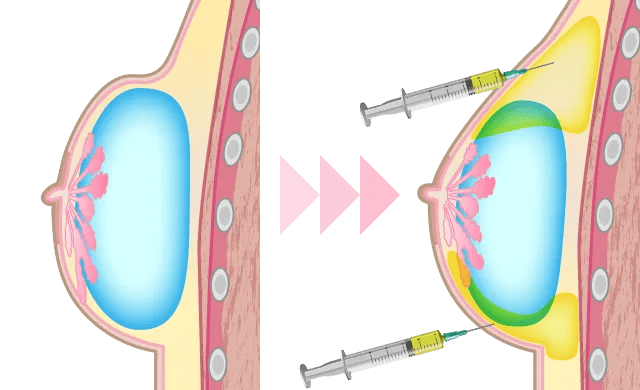 before:乳房の立ち上がりが急で不自然 after:バストが自然に見えるように、PRP注射で肌再生を促す