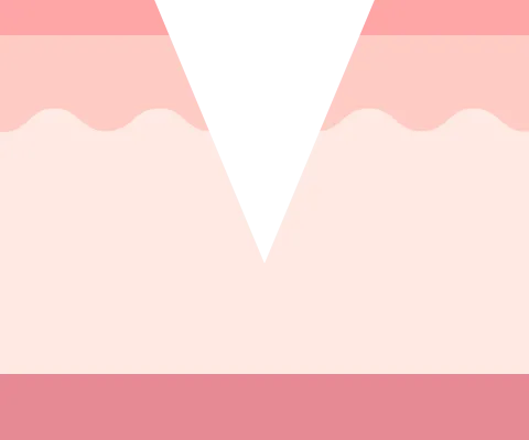 アイスピック型