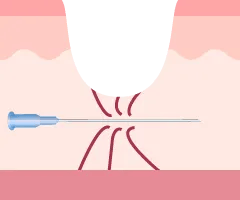 特殊な針で線維を切断