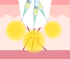 クレーター部分にPRP成分を注入