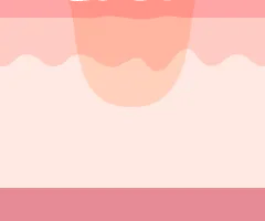 クレーター部分だけに肌再生が起こる