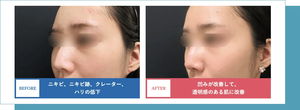 BEFORE ニキビ、ニキビ跡、クレーター、ハリの低下 AFTER 凹みが改善して、透明感のある肌に改善
