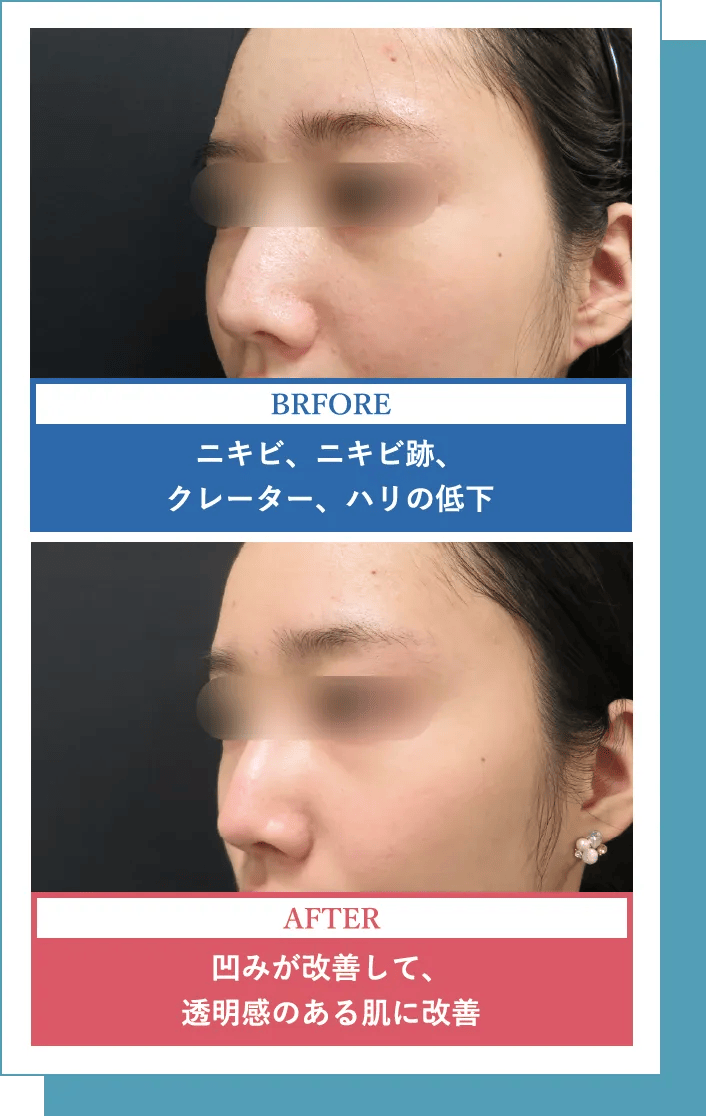 BEFORE ニキビ、ニキビ跡、クレーター、ハリの低下 AFTER 凹みが改善して、透明感のある肌に改善