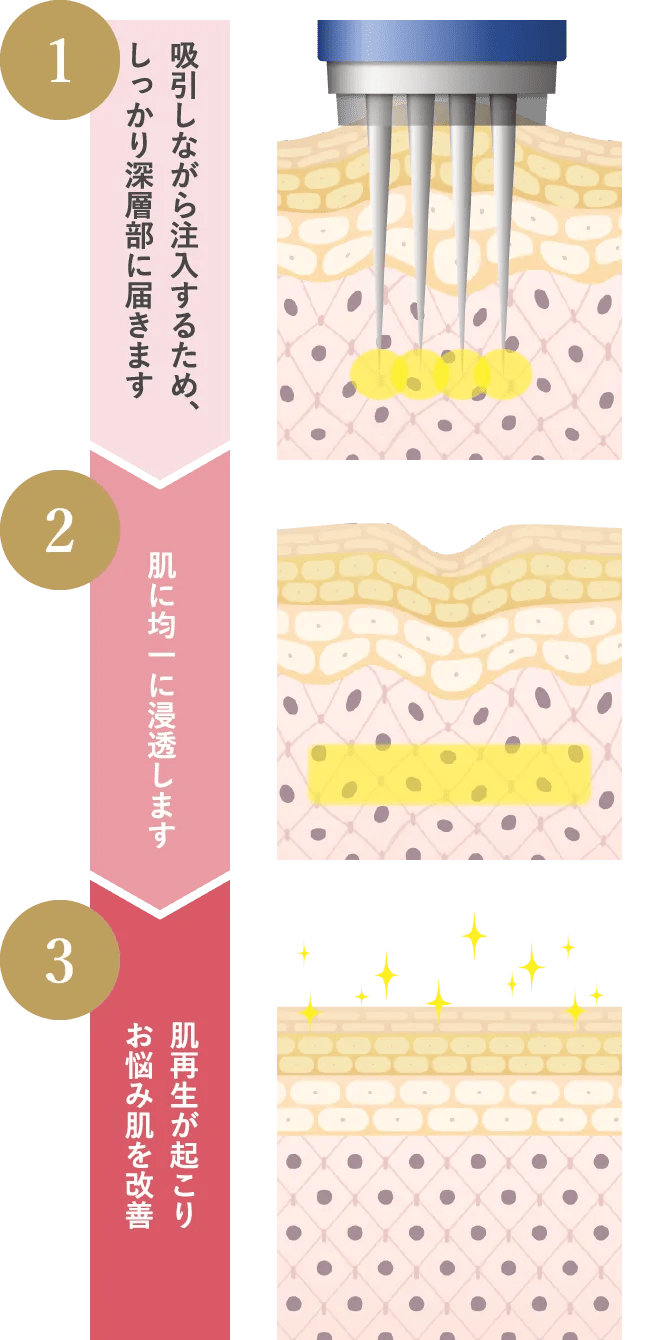 吸引しながら注入するため、しっかり深層部に届きます 肌に均一に浸透します 肌再生が起こりお悩み肌を改善