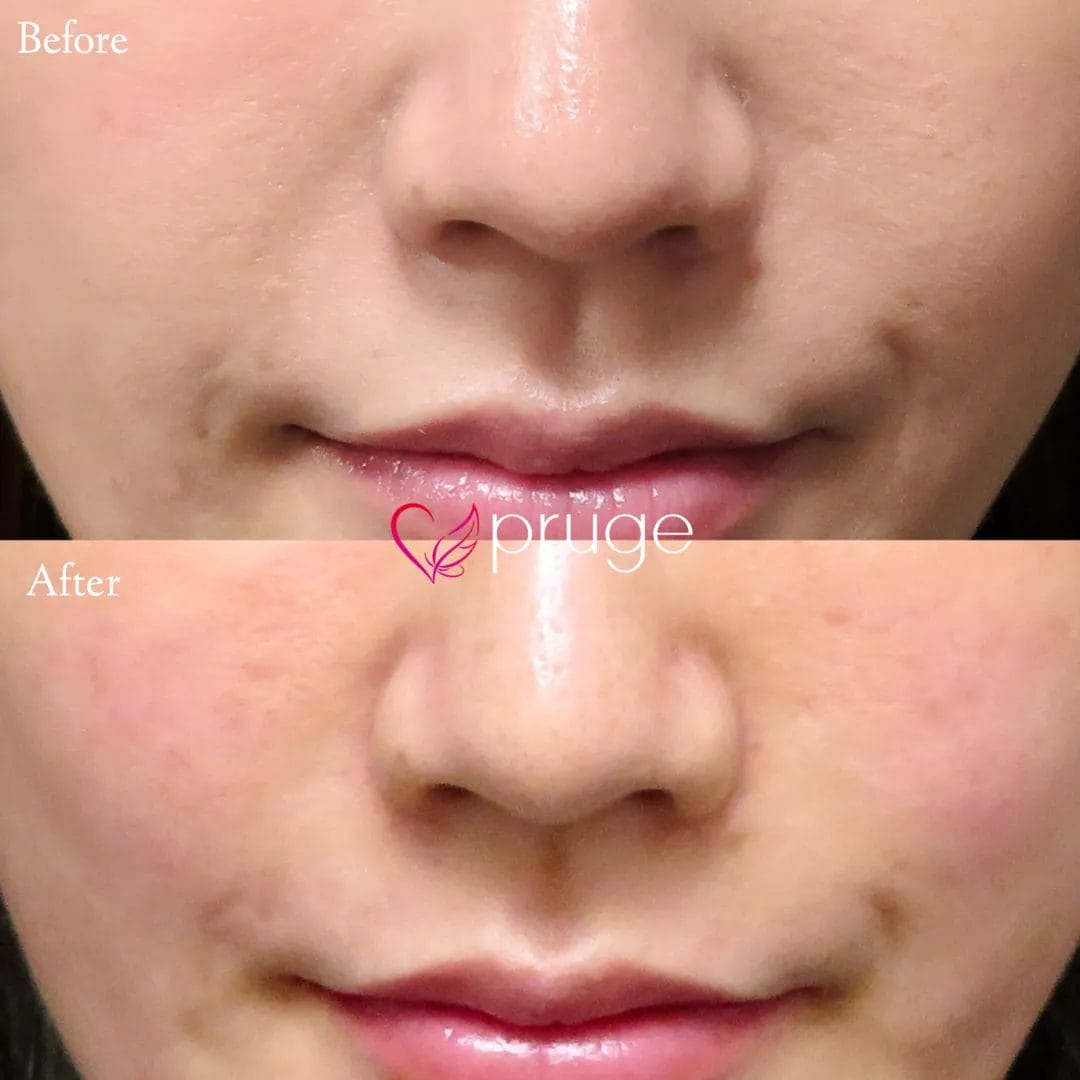 ご自身の血液から抽出したPRPを皮下組織に注入し、組織の修復効果が得られることで、症状が改善します。