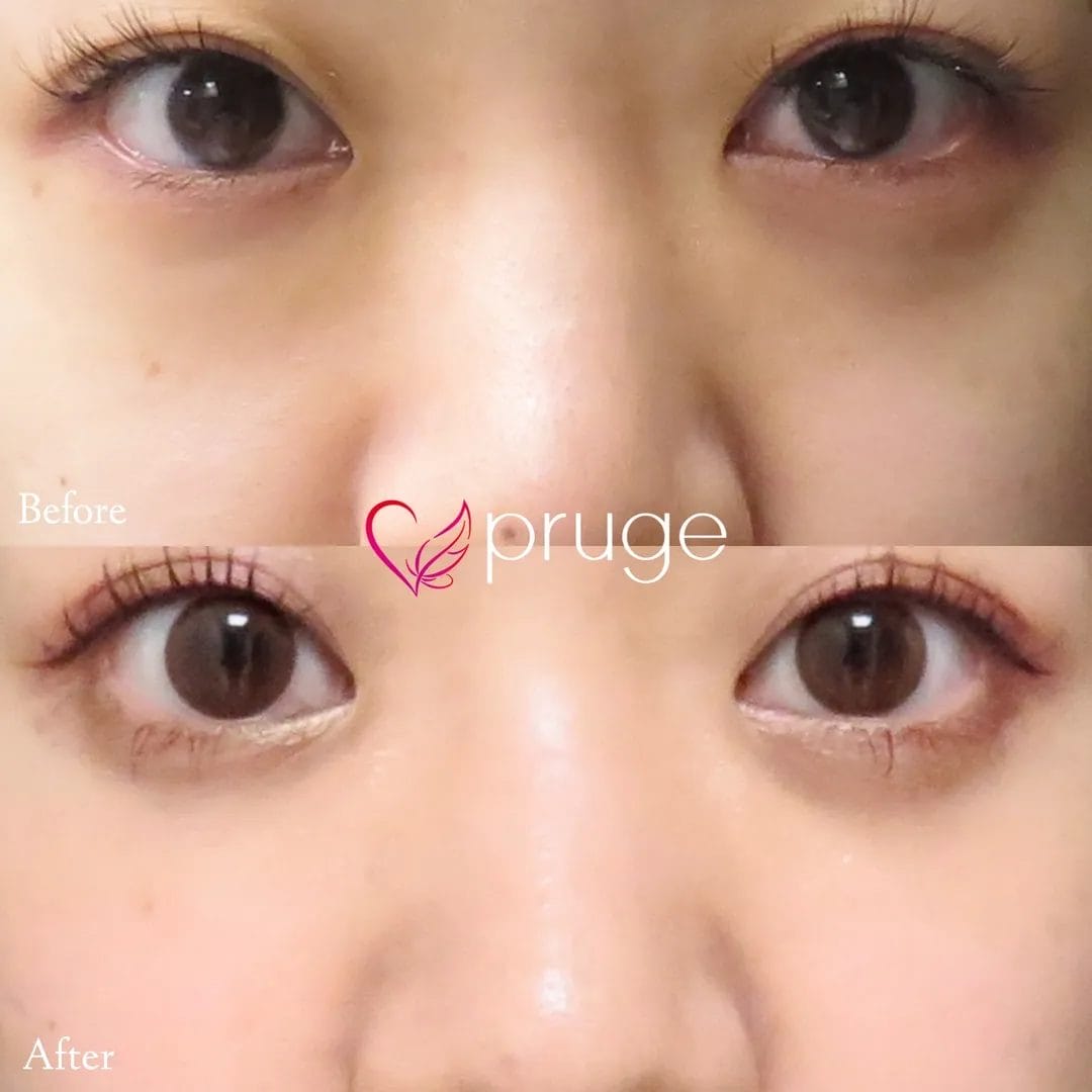 PRP-MI脱脂術（目の下）