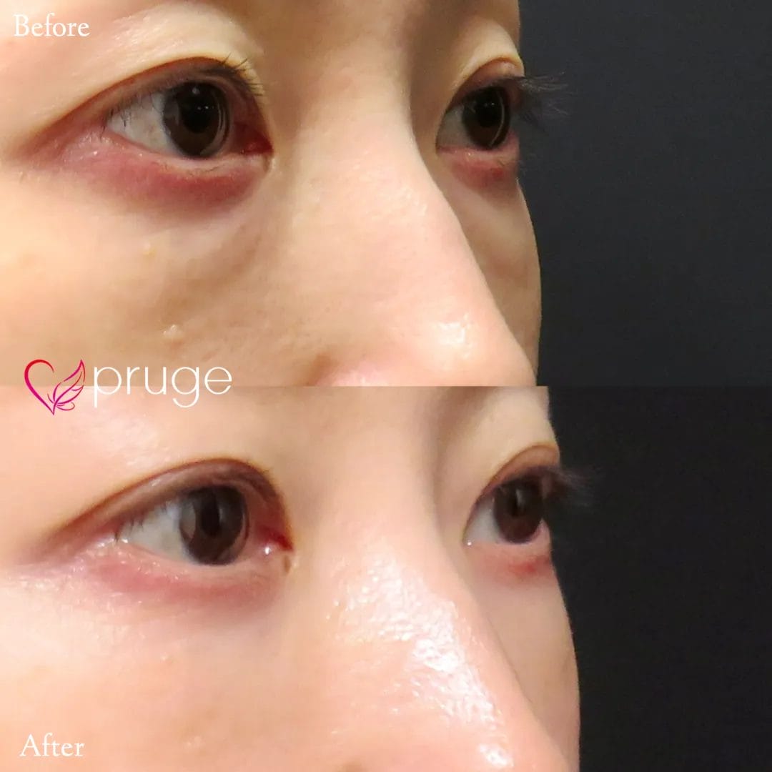 PRP-MI脱脂術（目の下）