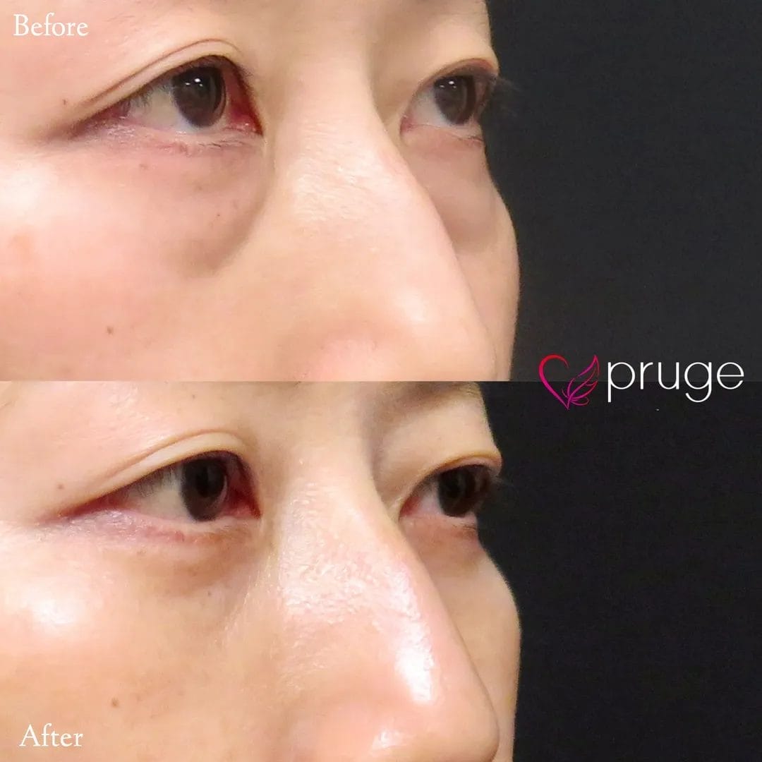 経結膜脱脂術で眼窩脂肪を取り除き、ご自身の血液から抽出したPRPを、皮下組織に注入し、組織の修復効果が得られることで、症状が改善します。