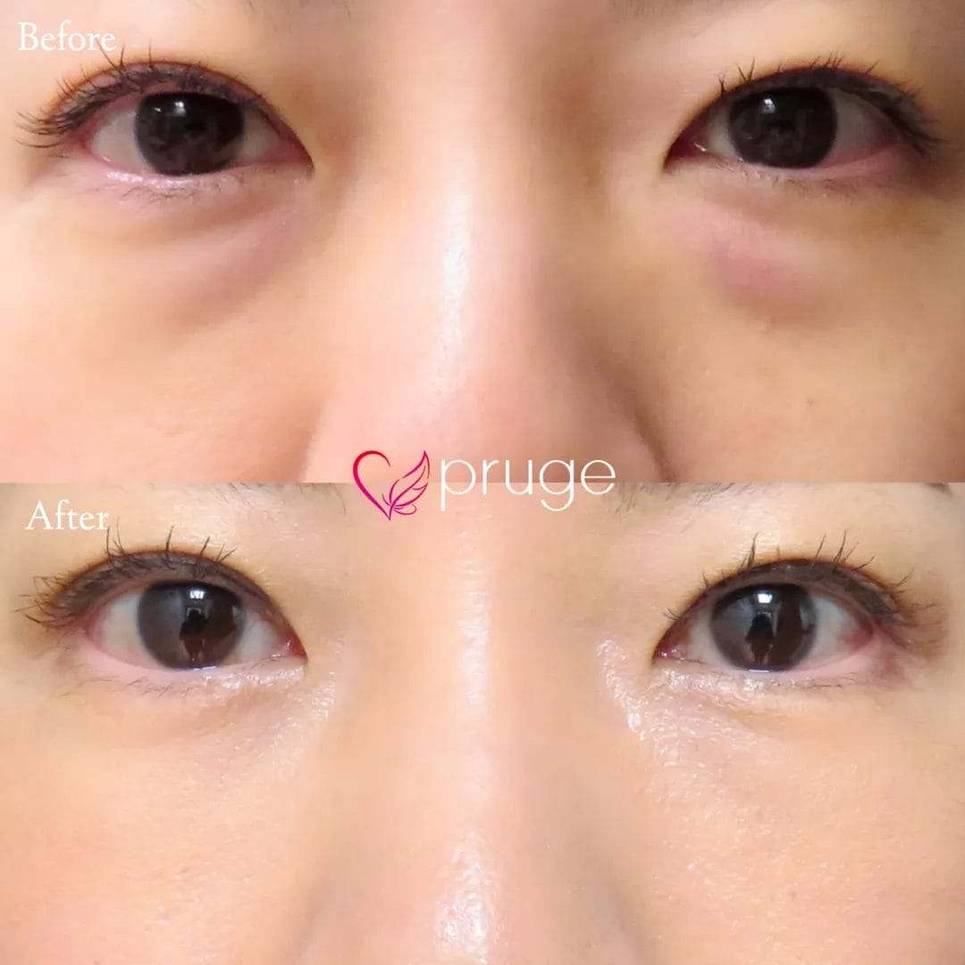 PRP-MI脱脂術（目の下）