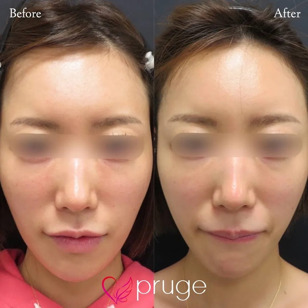 額・こめかみの凹み