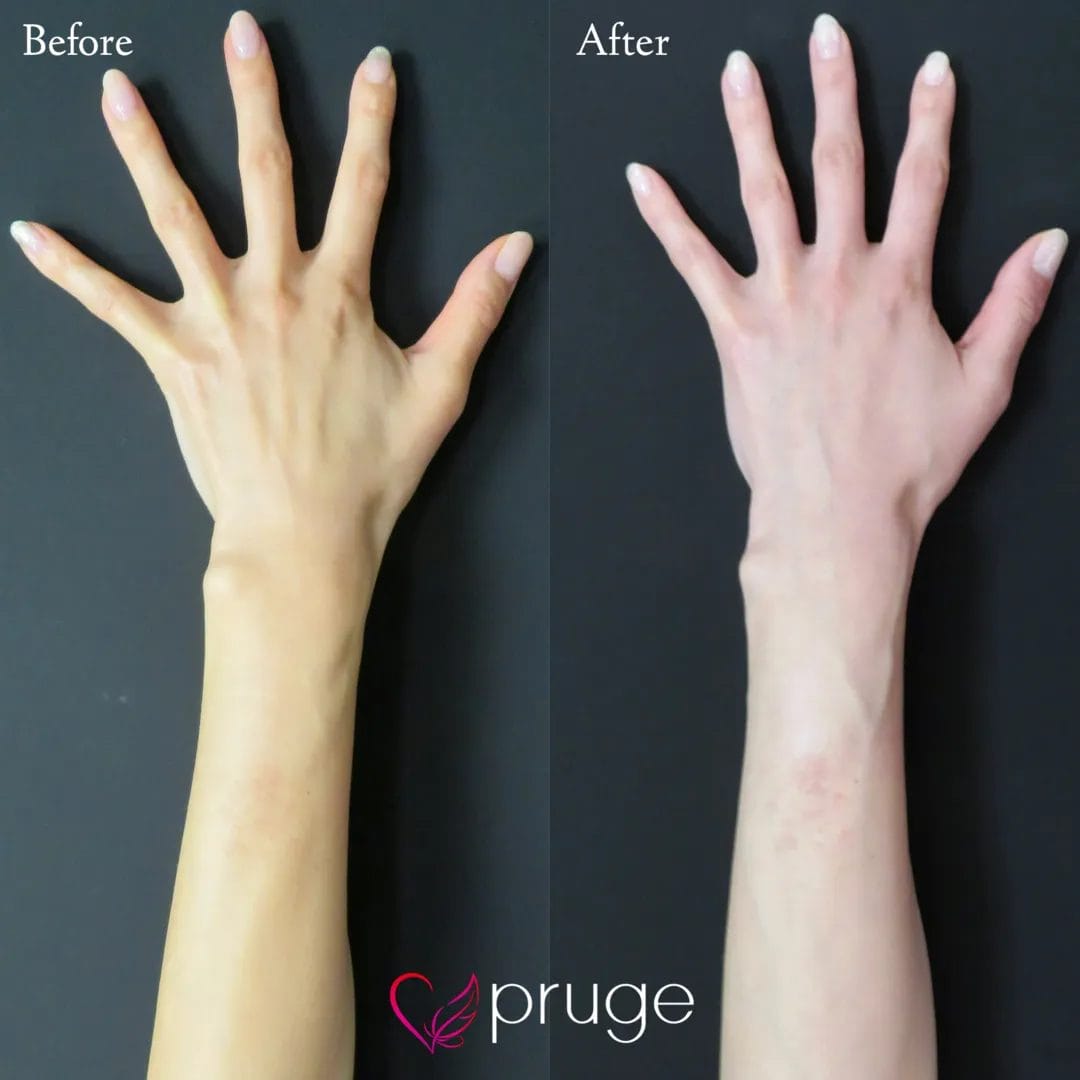 PRP注射（手の甲）