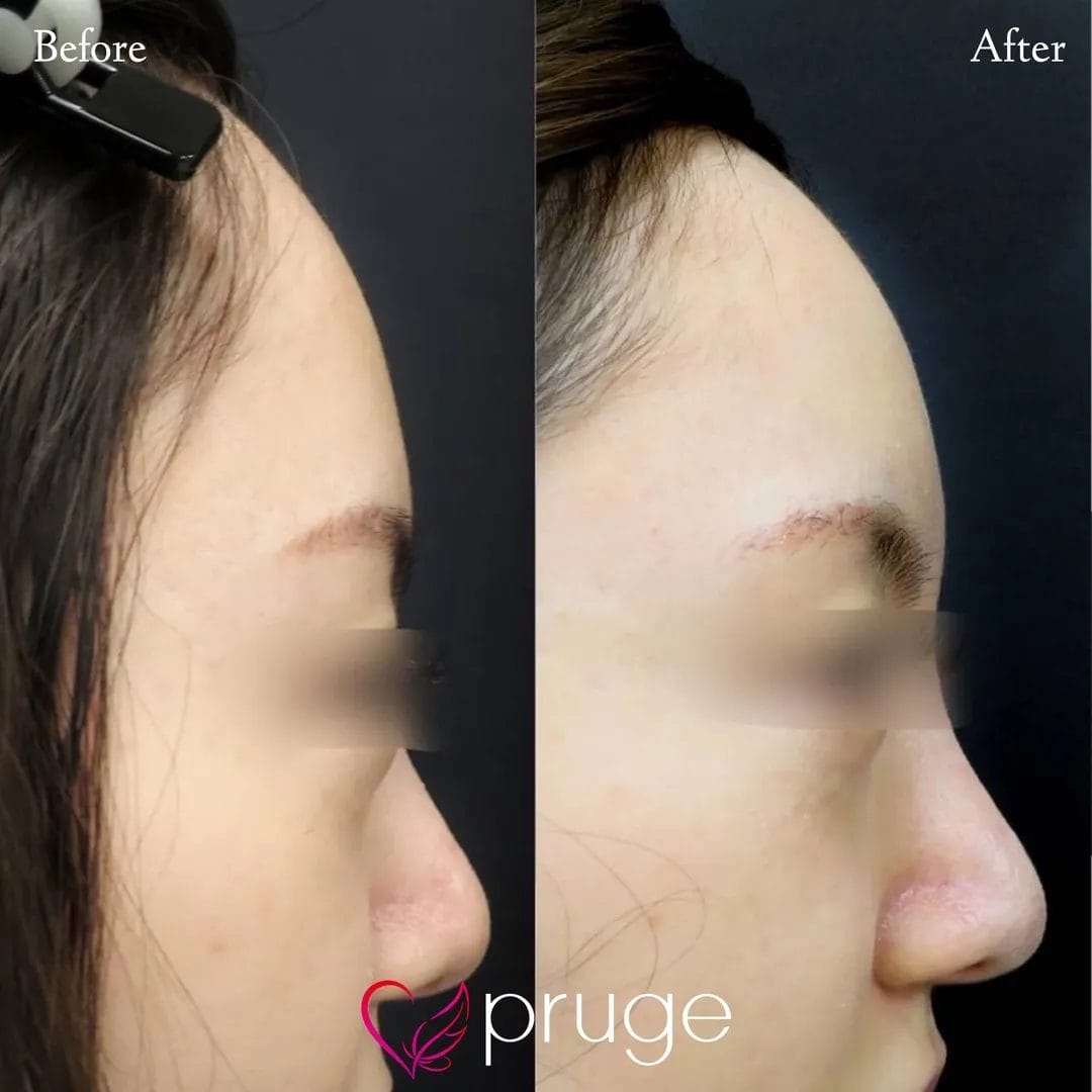 額・こめかみの凹み