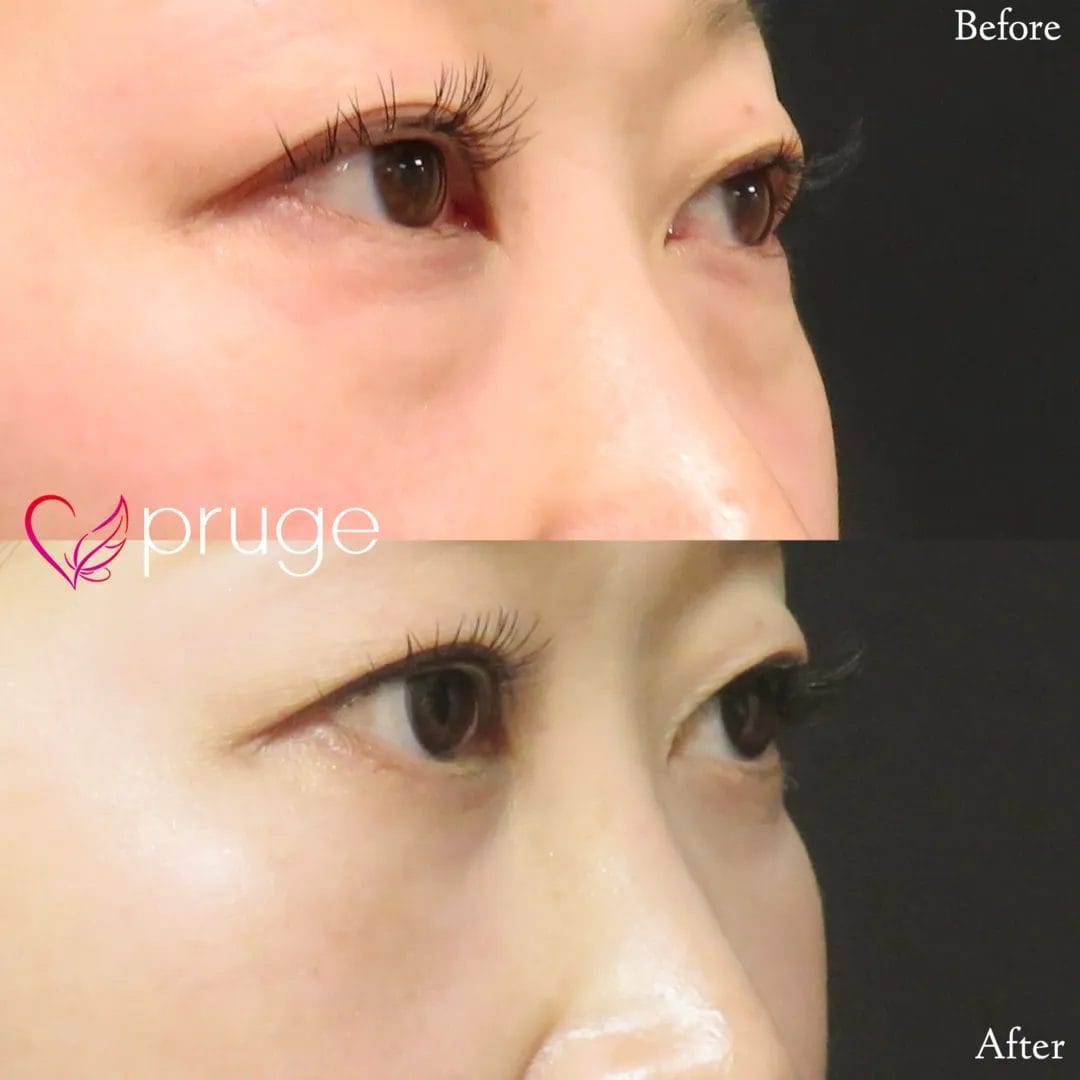 PRP-MI脱脂術（目の下）