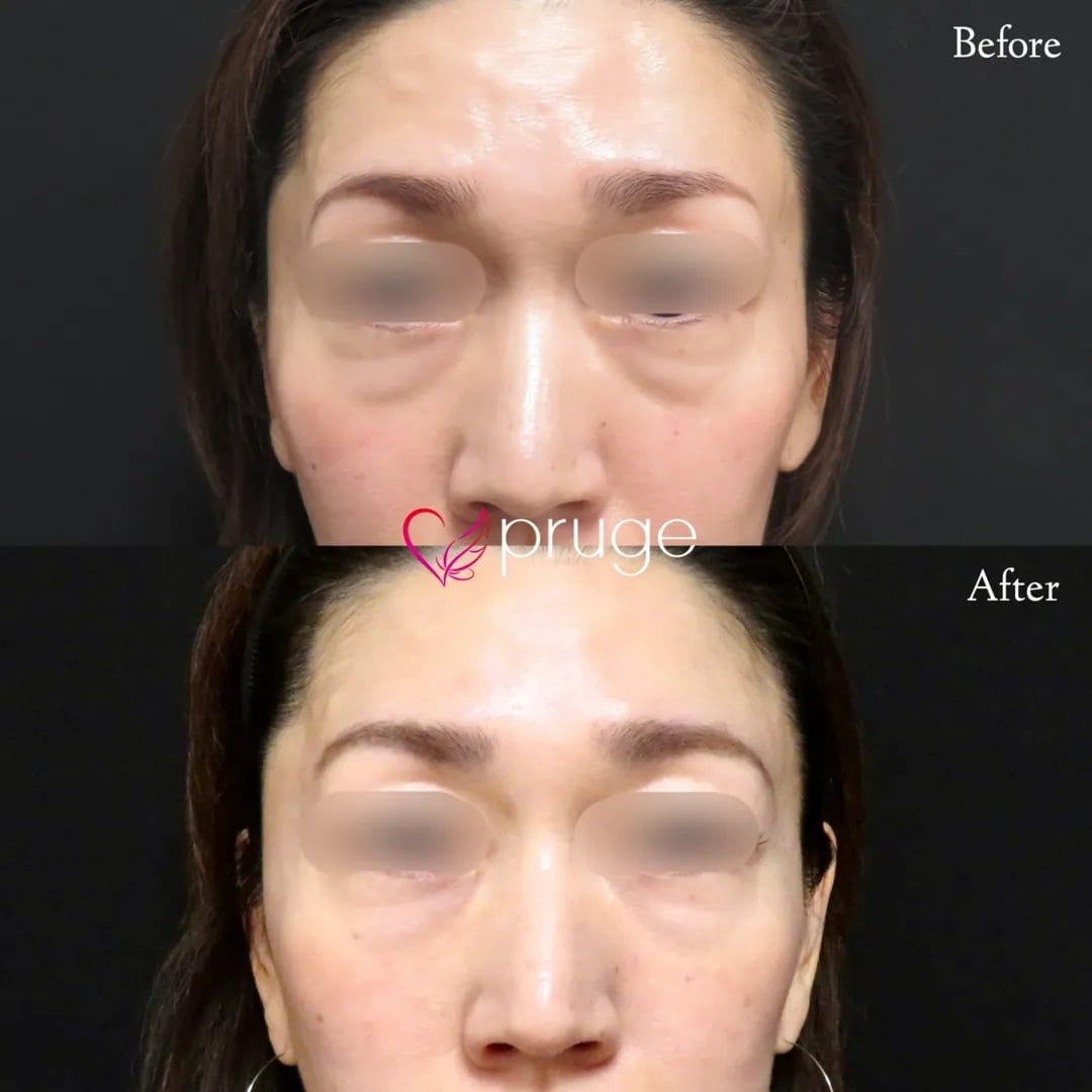 眉間の凹みと目の下のクマによる原因で、表情が男性の様に少し怖い印象になってしまいます。