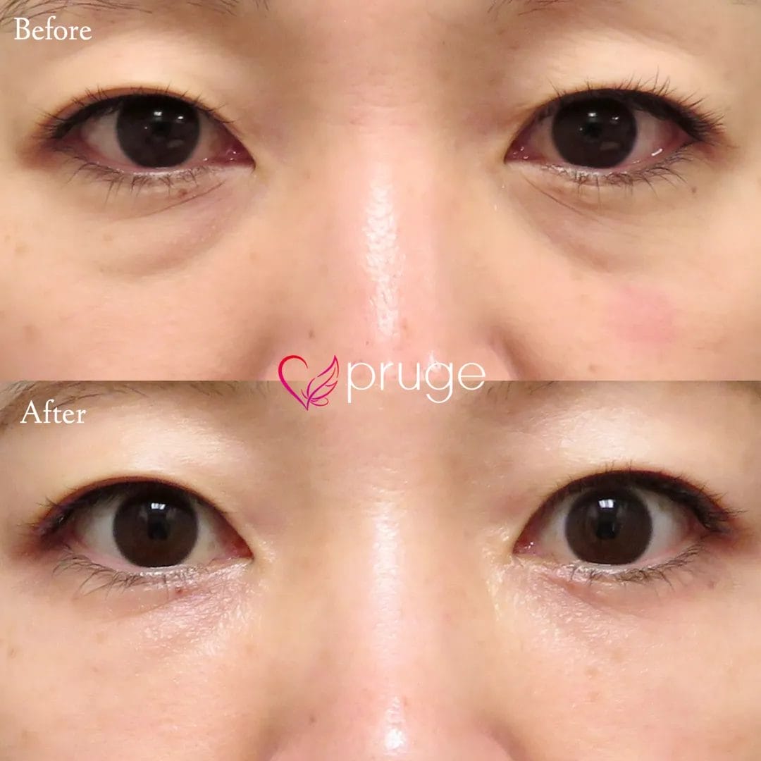 PRP-MI脱脂術（目の下）