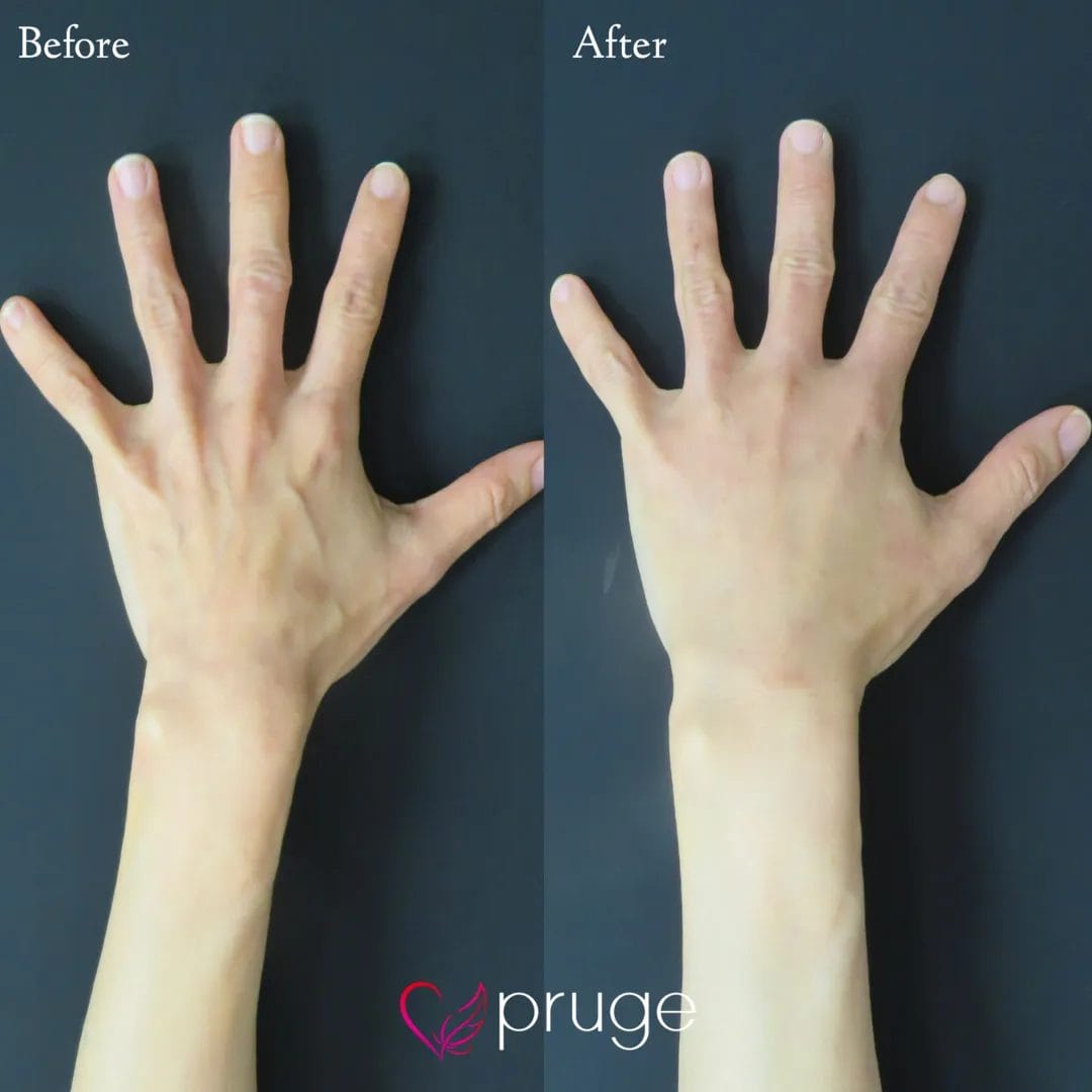 PRP注射（手の甲）