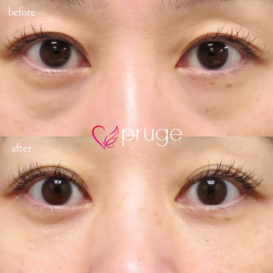 PRP-MI脱脂術（目の下）