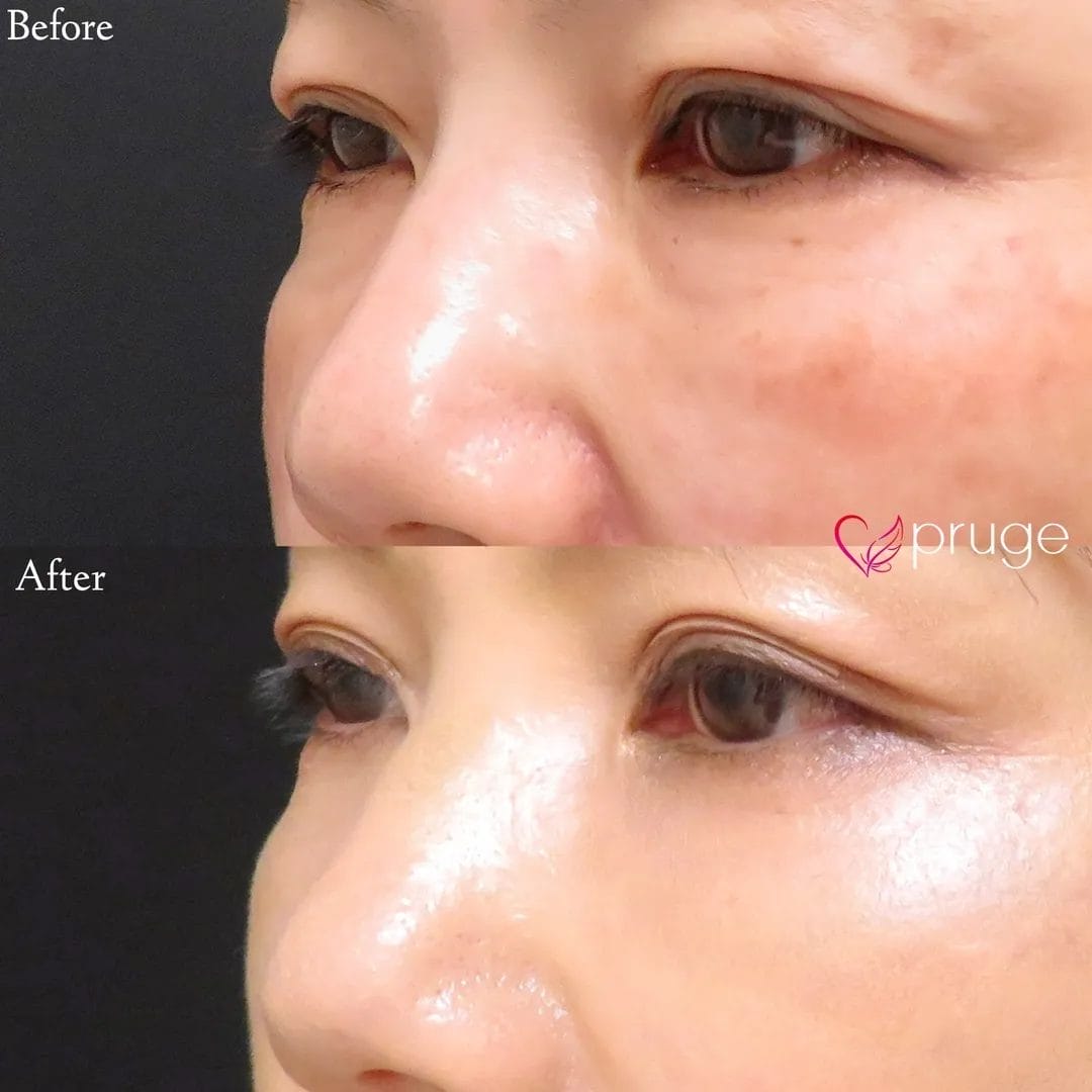 余分な脂肪を取り除くだけだと、凹みが強く出てしまう可能性や小じわが目立つようになってしまったりする可能性があるため、当院では脱脂術＋PRP注射を同時に行う『PRP脱脂術』をオススメしております。