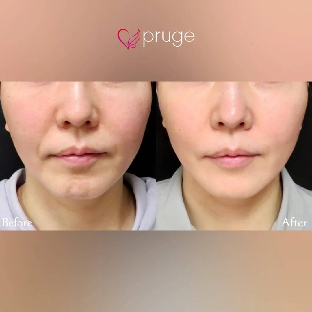 PRP注射（ほうれい線）