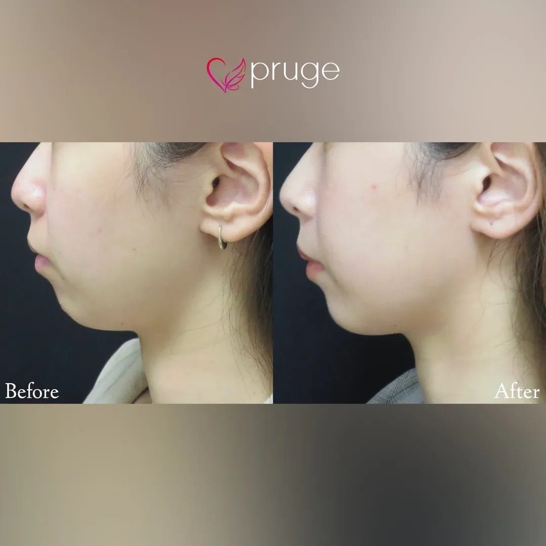 マッサージなどのセルフケアが続かず、より短い期間で効果的にケアしたい方にオススメな治療、スリム注射。