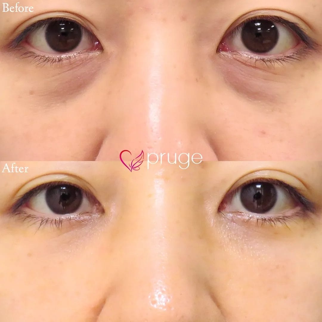 PRP-MI脱脂術（目の下）