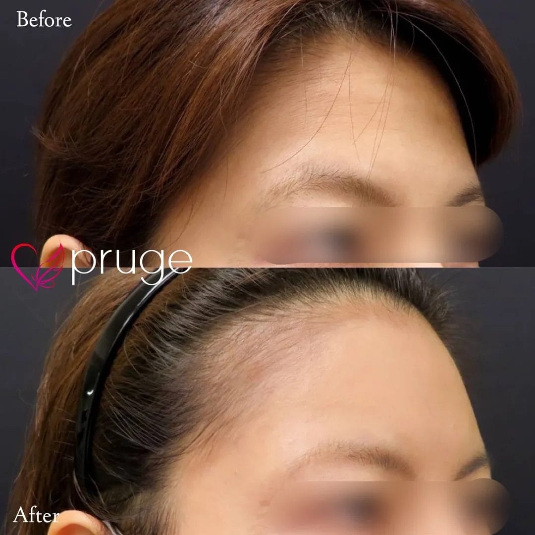 額・こめかみの凹み