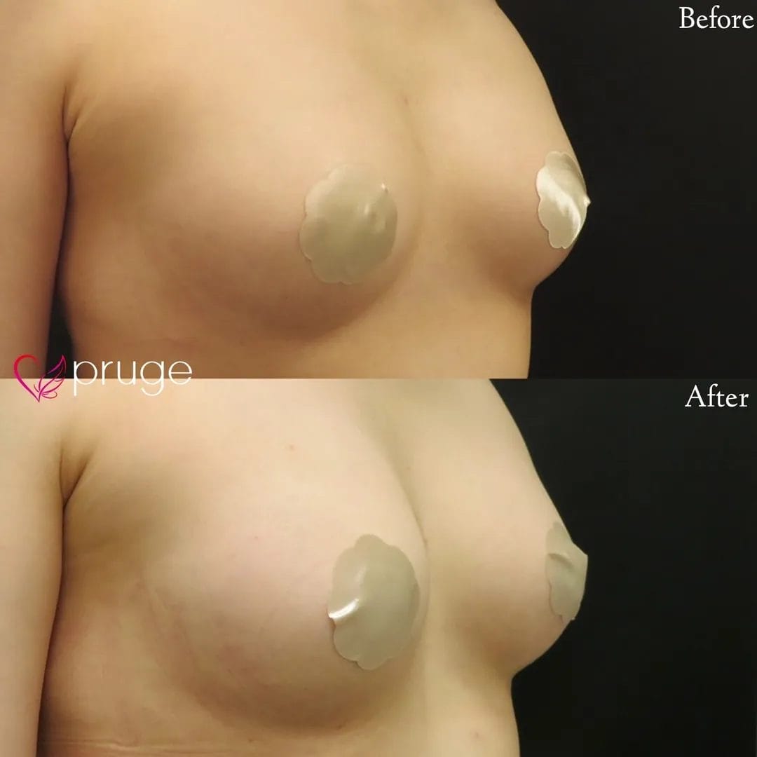 PRP注射によるバストアップ