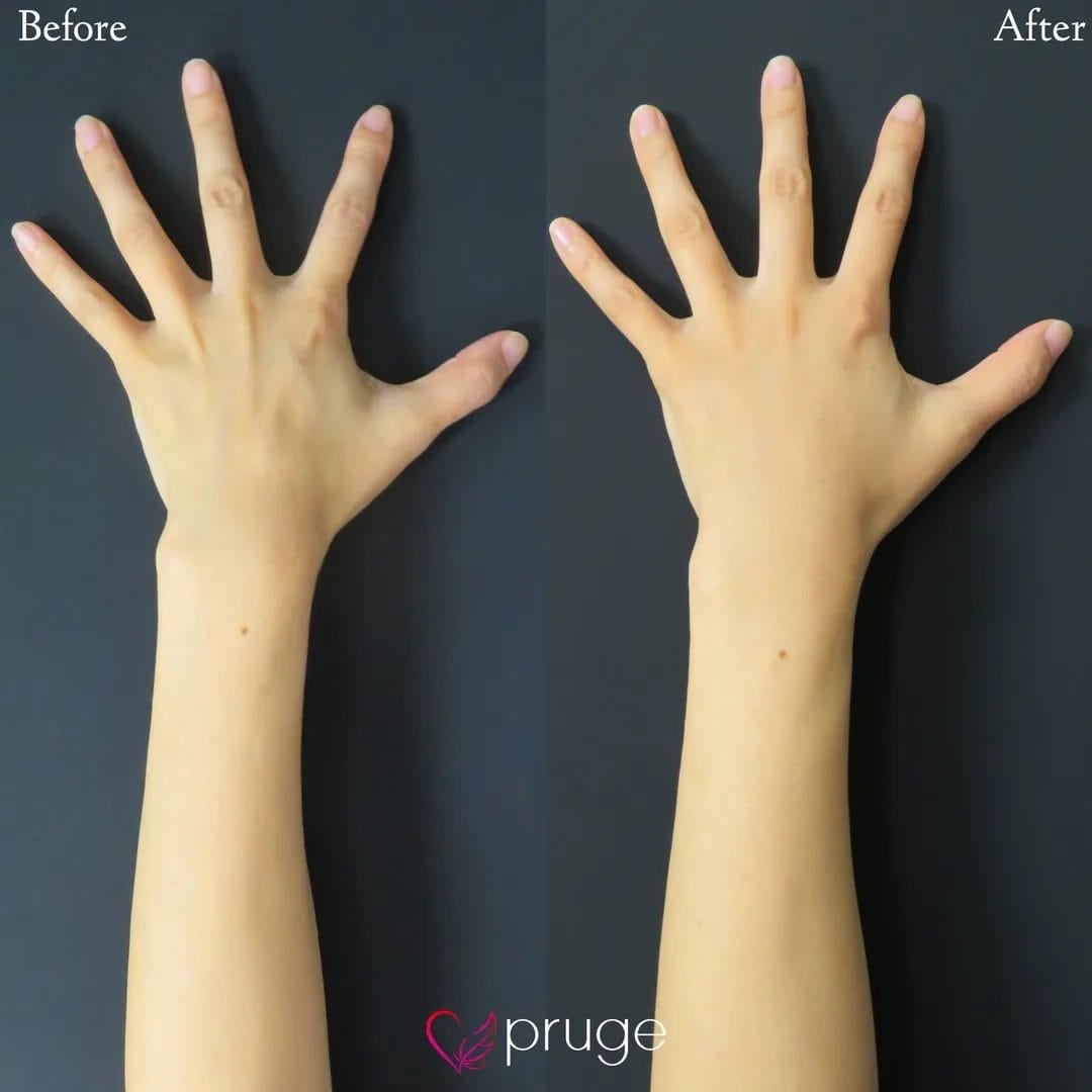 PRP注射（手の甲）