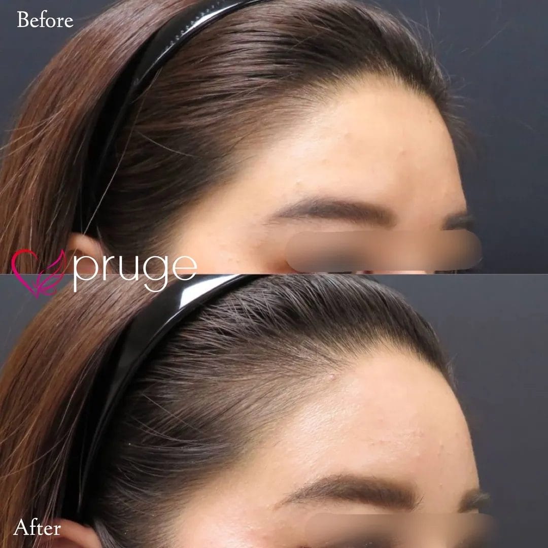 額の傾斜・凹み