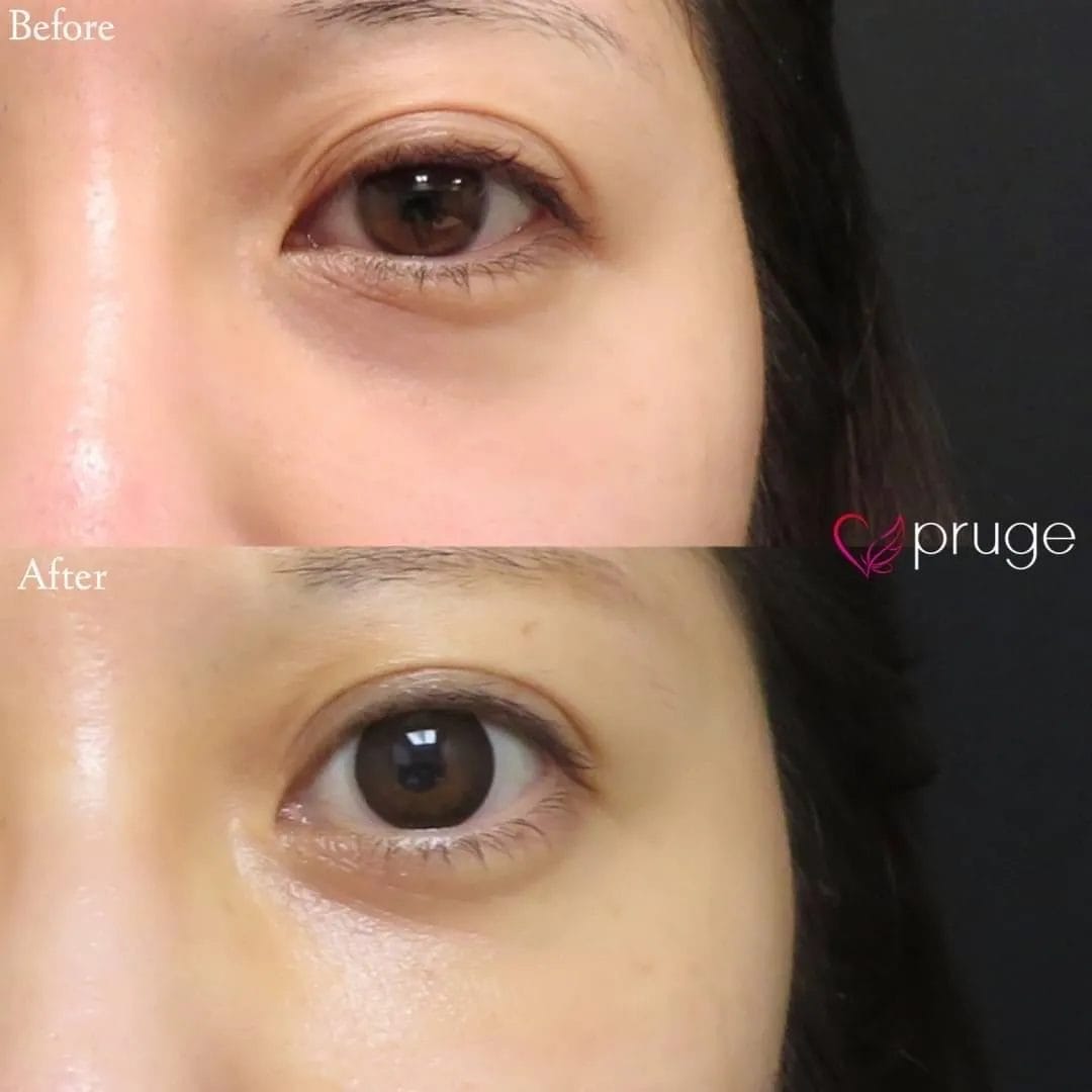 PRP-MI脱脂術（目の下）