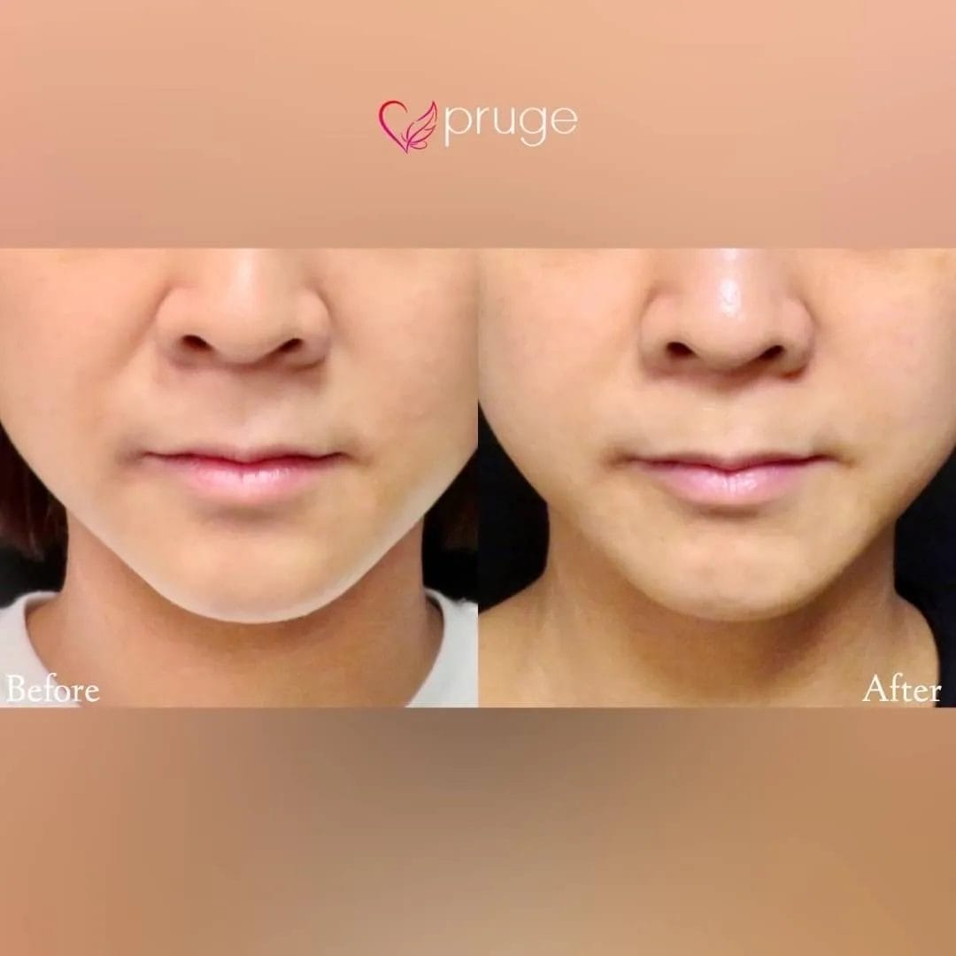 凹んだ小鼻の付け根(鼻翼基部)周辺をボリュームアップさせ、ほうれい線を目立たなくすることができ、ヒアルロン酸では注入出来ない部位もPRP注射ならしっかり改善。