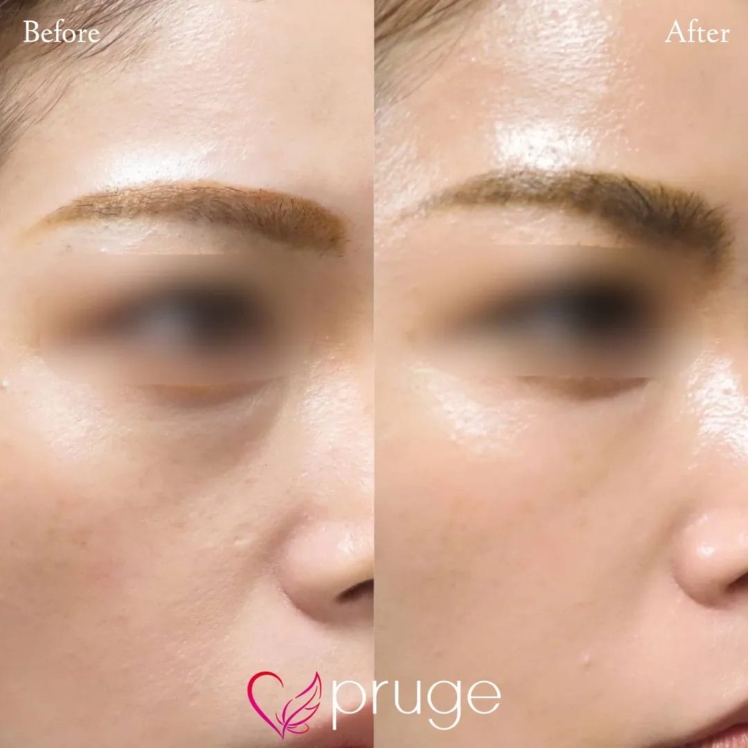 目の下のクマ・ゴルゴライン