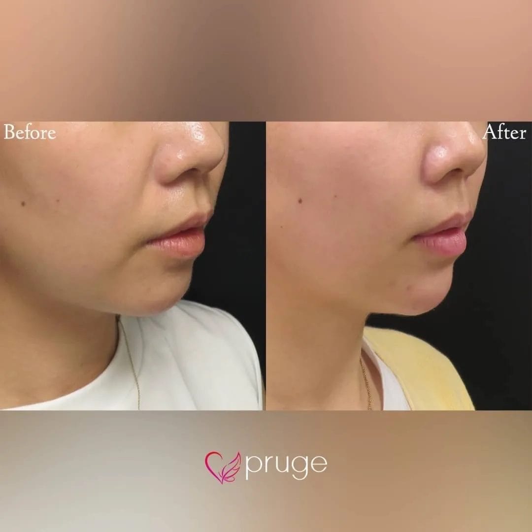 アゴ先を出して、フェイスラインをシャープに見せたいとご希望でPRP注射をお受けいただきました。