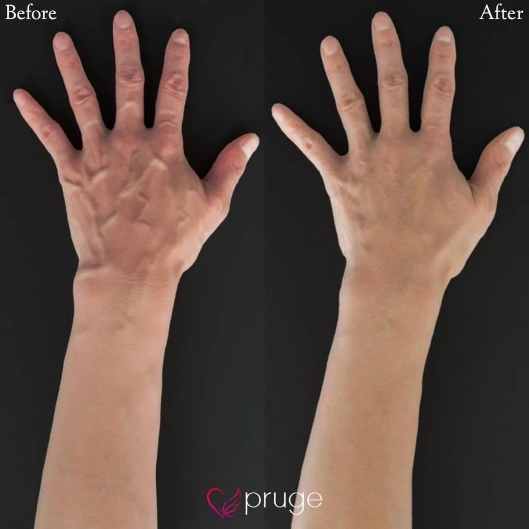 ハンドベイン（レーザー療法）