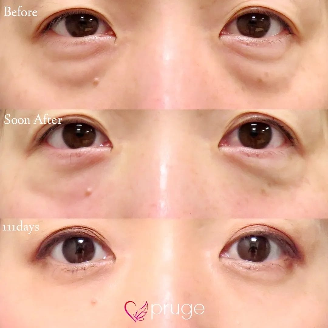 PRP-MI脱脂術（目の下）